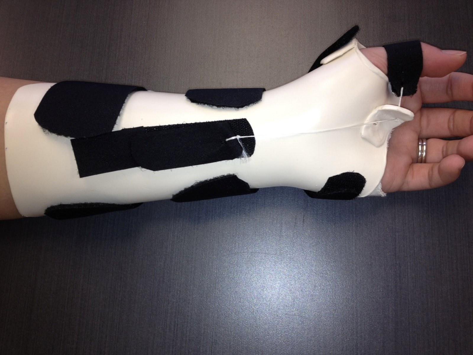 A custom-fabricated thermoplastic hand and wrist splint with straps